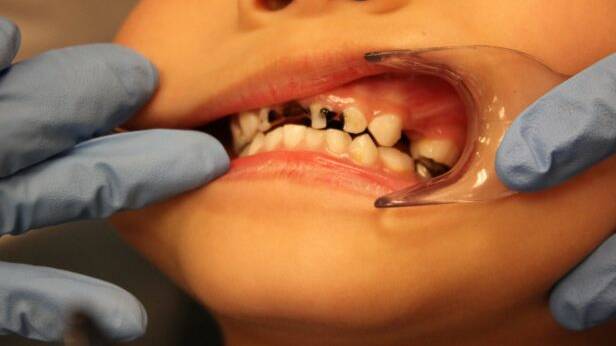A five-year-old child with extensive tooth decay.  Photo: Dental Health Services Victoria