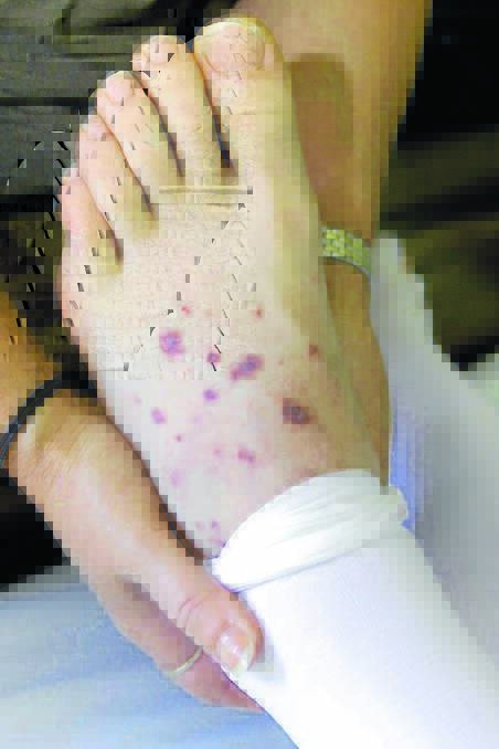 Dangerous sign: The purple rash often seen with meningococcal disease.