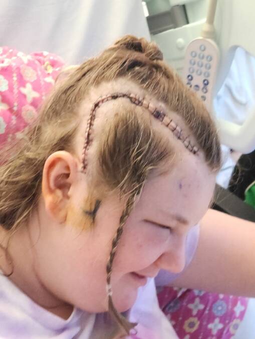 Eloise O'Donnell is healing after neurosurgery to remove part of the right side of her brain after being diagnosed with Rasmussen Encephalitis earlier this year. Pictures supplied