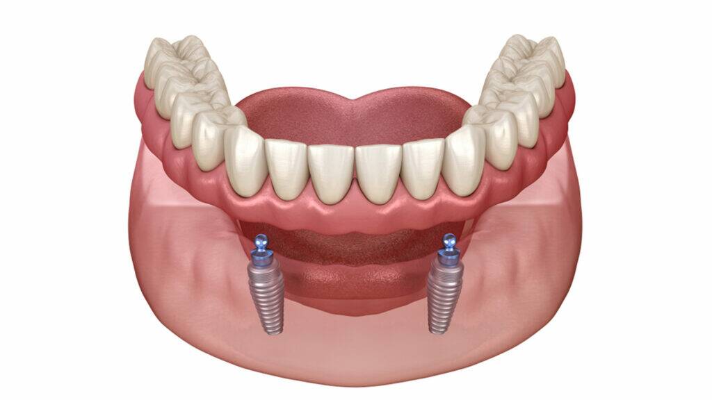 Titanium implants are inserted into the jaw bone and the dentures are then stabilised via an o-ring clip system. Picture supplied, 