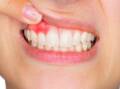 Inflamed gums are a symptom of gum disease. Picture Shutterstock