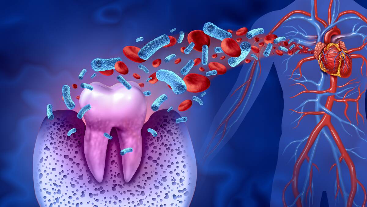 The spread of bacteria from the mouth to the bloodstream can contribute to the development of cardiovascular problems. Picture Shutterstock